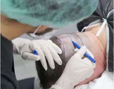 Hermest Hair Transplant Center, Turkey