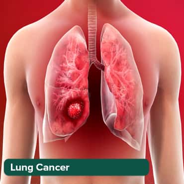 Lung Cancer Treatment