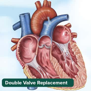 Double valve replacement (DVR)