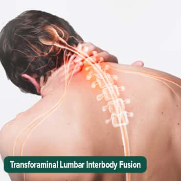 ትራንስፎርሜናል ላምባር ኢንተርቦል ፊውዥን (TLIF))