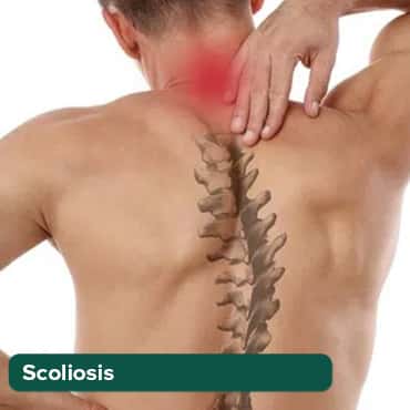 Scoliosis