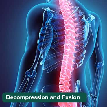 Decompression and Fusion