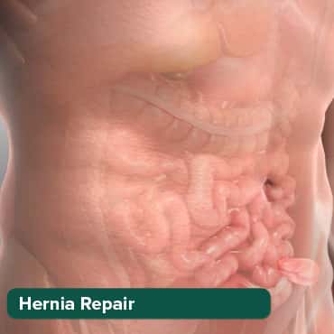 Pembaikan Hernia Laparoskopik