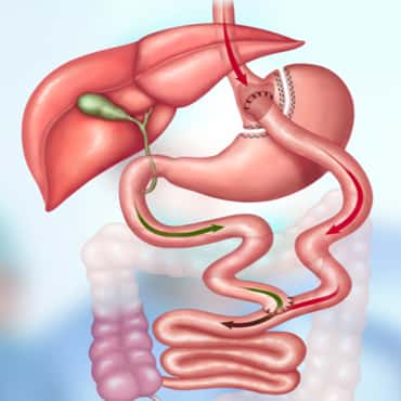 Gastric Bypass