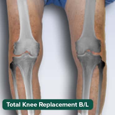 Total Knee Replacement-B/L