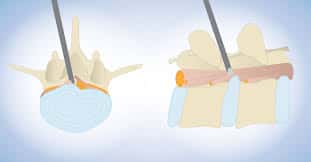 Microdiscectomy / Laminectomy