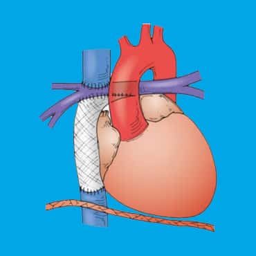 Bidirectional Glenn (BDG) shunt