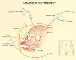 Лапароскопическая цистэктомия