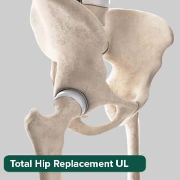 Total Knee Replacement-U/L