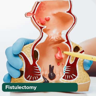 Fistulectomy