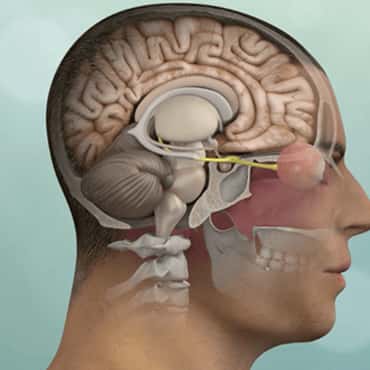 Craniotomy